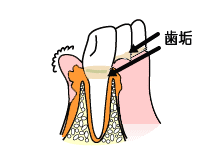 歯肉炎の状態